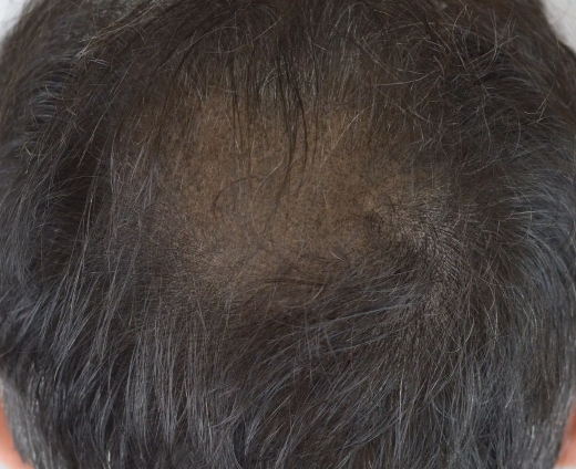 tricopigmanetazione capelli lunghi densità post